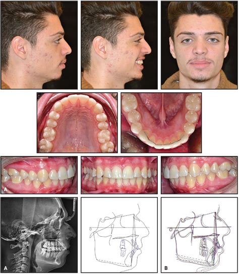 Functional Class Ii Treatment With A Miniplate Anchored Herbst Appliance Jco Online Journal