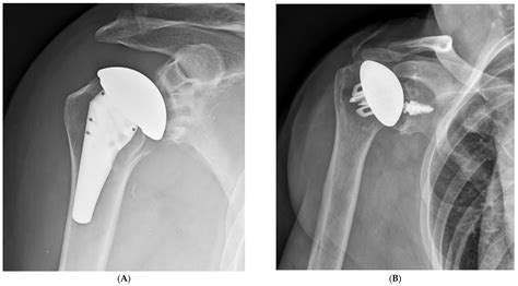 Jcm Free Full Text Current Concepts In Humeral Component Design For