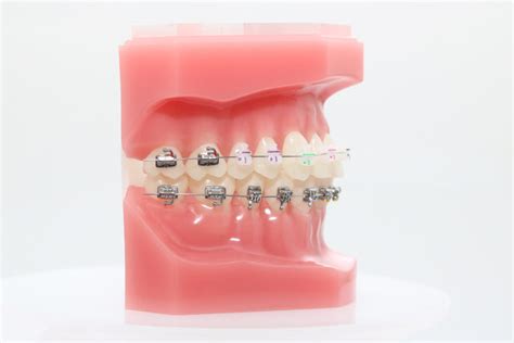 Clear Sl Keramik Bracket Greiner Orthodontics