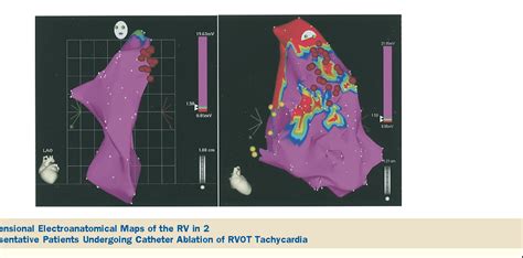 Figure 3 From Three Dimensional Electroanatomical Voltage Mapping And