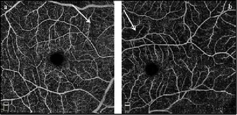 Purtscher’s Like Retinopathy Following Acute Pancreatitis Semantic Scholar