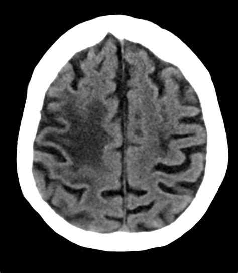 Fileacute Right Mca Infarct Meningioma And Retinal Detachment Ct