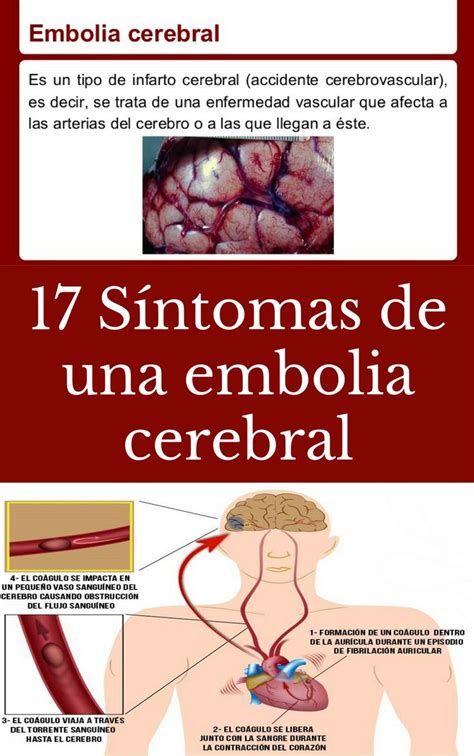 17 Síntomas de una embolia cerebral Tips Life vida Salud Remedios