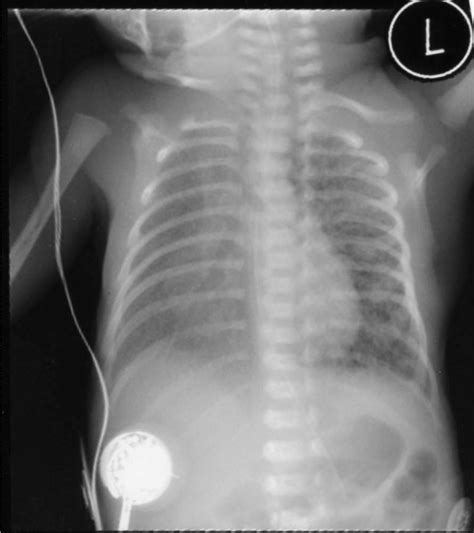 Interstitial Edema Chest X Ray