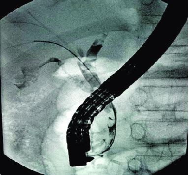 Endoscopic Retrograde Cholangiogram Revealing Guide Wire In Bile Duct