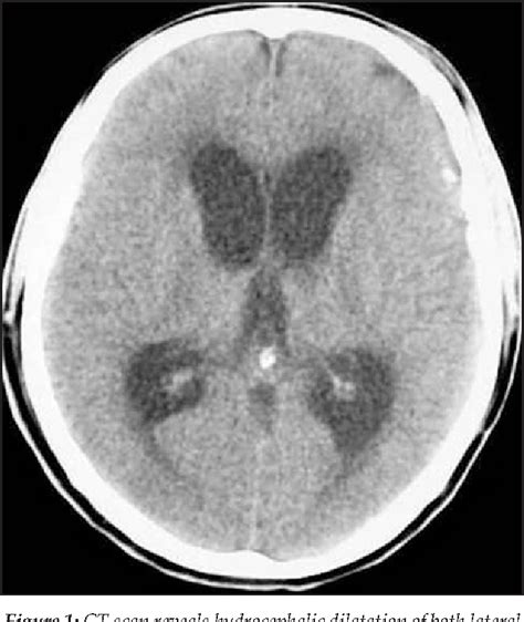 Figure From Delayed Intraventricular Tension Pneumocephalus Due To