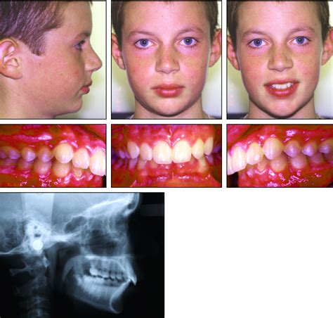 Twin Force Bite Corrector For Class Ii Molar Distalization