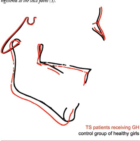 Figure 1 From Craniofacial Morphology In Turner Syndrome Patients