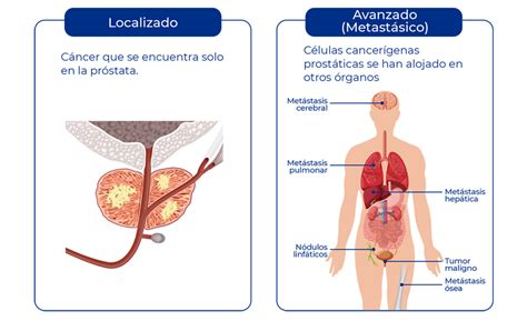 Diagn Stico Y Etapificaci N Cl Nica Ciudad Del Mar