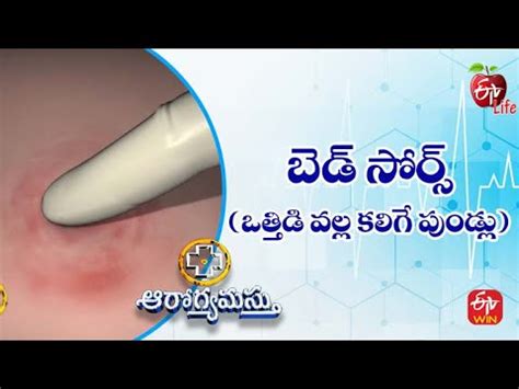 Pressure Sores బడ సరస ఒతతడ వలల కలగ పడల