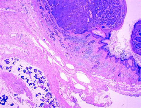 Case 1 Strands Of Basal Cell Carcinoma Bcc Are Directly Adhered To Download Scientific