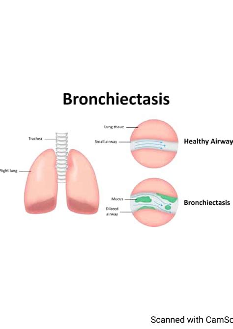 Solution Bronchiectasis Surgical Nursing Notes Studypool