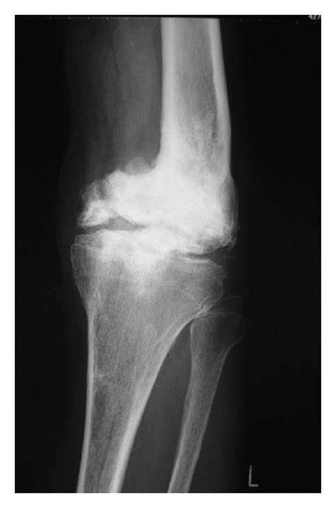 Preoperative Condition A B Anteroposterior And Lateral X P Plain