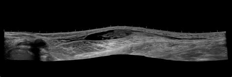 Baker's Cyst On Ultrasound