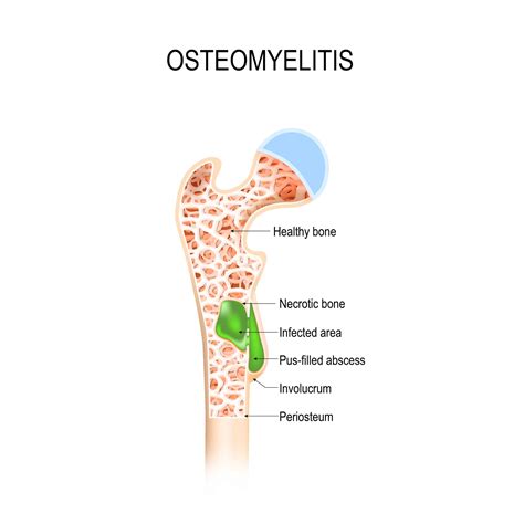 Treatment Infection Of Bone at Fred Morales blog