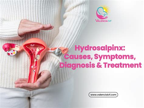 Hydrosalpinx: Causes, Symptoms, Diagnosis & Treatment - Valencia IVF