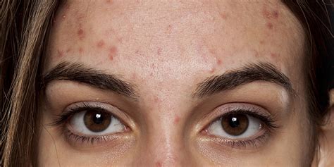 Nodular Acne Causes Treatments Options And Prevention Tips