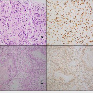 Grade 3 and 4 tumors. A & B: Anaplastic astrocytoma (grade 3)-like ...