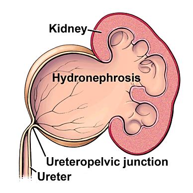 Pelvi-ureteric junction obstruction (PUJO) | Oxford Urology Associates