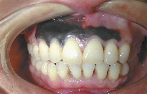 Gingival Melanoma Medizzy