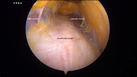 Quadriceps Graft Cork Surgery Orthopaedic Sports Medicine Surgery