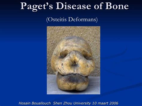 pagets disease  bone exercise  nelson shields blog