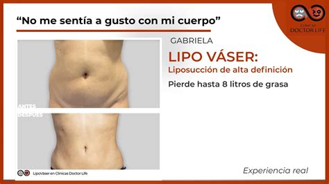 Liposucci N De Alta Definici N Lipo V Ser Cl Nicas Doctor Life Youtube