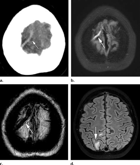 Isolated Cortical Vein Cvt In An 11 Year Old Boy With Acute Lymphocytic