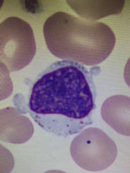 Peripheral blood smear showing a large granular lymphocyte and a... | Download Scientific Diagram