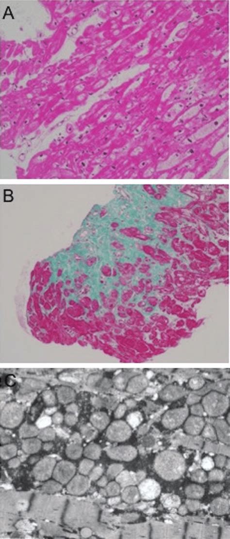 Histopathological Findings A Myocardial Biopsy From The Endometrium Of