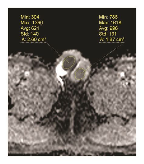 The Right Testicle Shows High Signal Intensities On Dwi A In The Adc