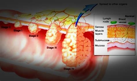 Esophagus Cancer | Health News