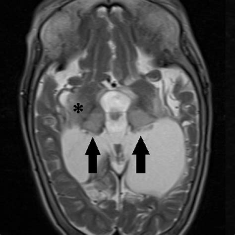 Severe hypoxic-ischemic encephalopathy. Axial T2-weighted MRI sequence ...