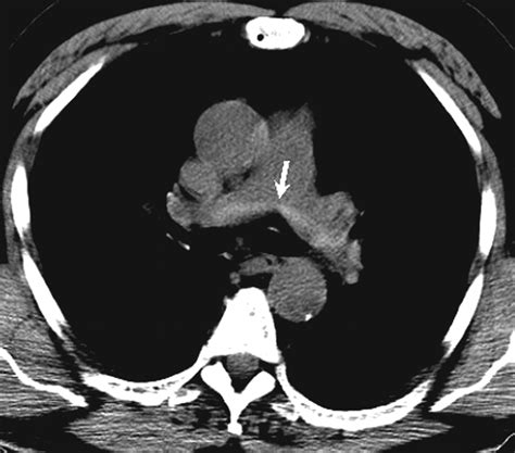 Six Cases Of Acute Central Pulmonary Embolism Revealed On Unenhanced Multidetector Ct Of The