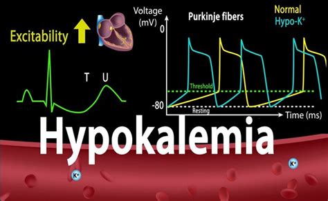 Hypokalemia Disease With Causes Symptom And Nursing Intervention