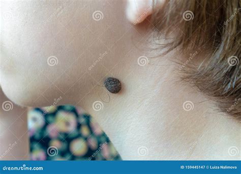 Big Birthmark On The Neck Of A Child Mole With Hairs Stock Image