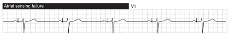 Assessment Of Pacemaker Malfunction The Cardiovascular