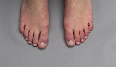 What are COVID toes? - MyDr.com.au