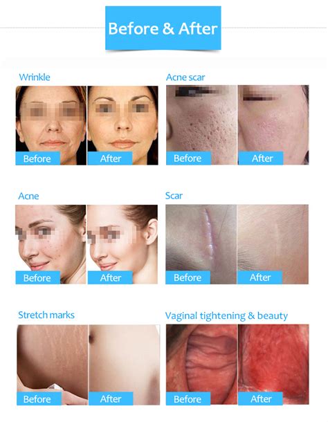 Sm D Co Fractional Laser Acne Scar Removal Vaginal Tightening