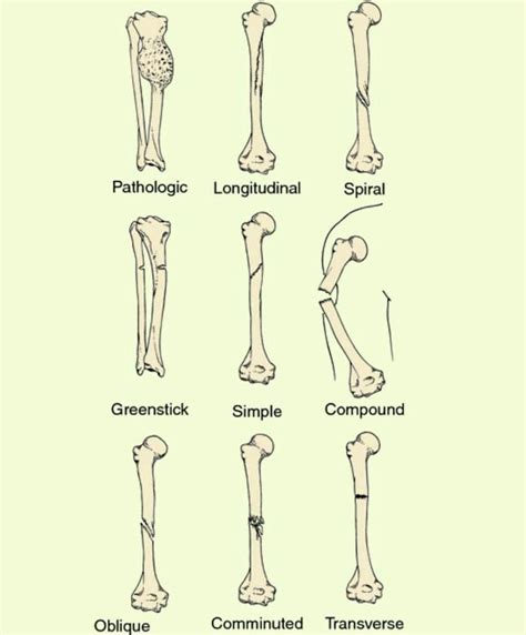 Complicated Fracture