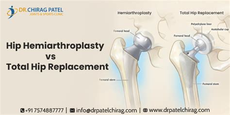 Hemiarthroplasty For Femoral Neck And Head Fractures With 57 Off