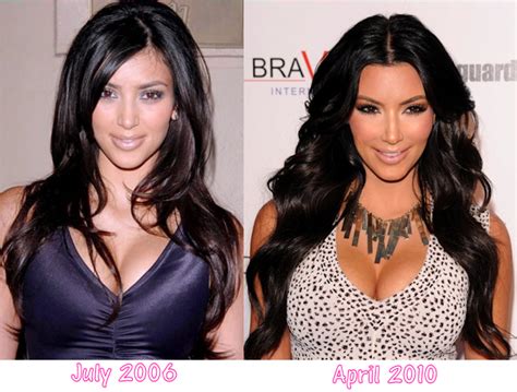 Has Kim Kardashians Have Plastic Surgery Before And After Photos Breast Implants Botox Injects