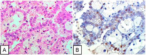 Papillary Cell Renal Cell Carcinoma Cells Diffusely Positive For