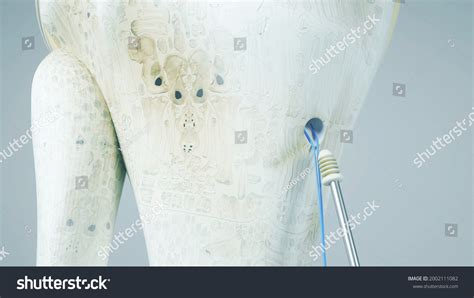 Knee Surgery Torn Tendon Repair Ligament Stock Illustration 2002111082 | Shutterstock