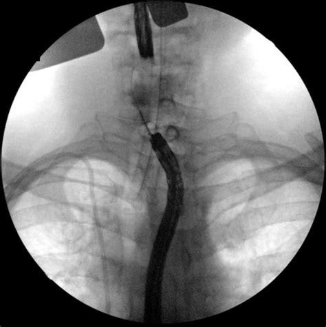 Fluoroscopy with contrast confirming complete obstruction. | Download ...