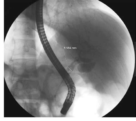 Endoscopic Retrograde Cholangiopancreatography Ercp Digital Image Of