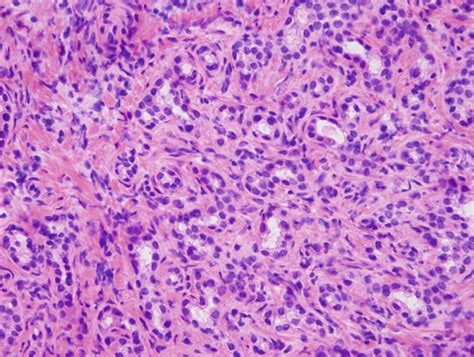 Bile Duct Adenomas Contain Proliferating Tubules Lined By Cuboidal