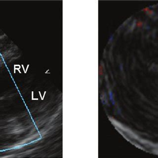 Muscular VSD. Short-axis views from echocardiography and real-time... | Download Scientific Diagram