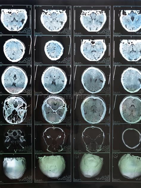 MRI of the Brain after Trauma Stock Photo - Image of patient, disease ...