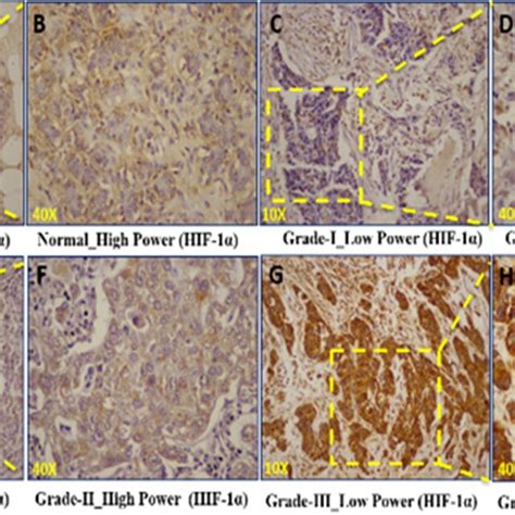 Immunohistochemical Expression Of Hypoxia Inducible Factor 1 Alpha Download Scientific Diagram